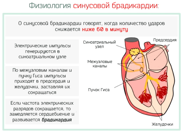 Брадикардия сердца — что это такое, причины, симптомы и лечение, профилактика 