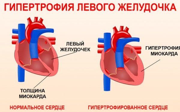 Гипертрофия миокарда левого желудочка сердца 