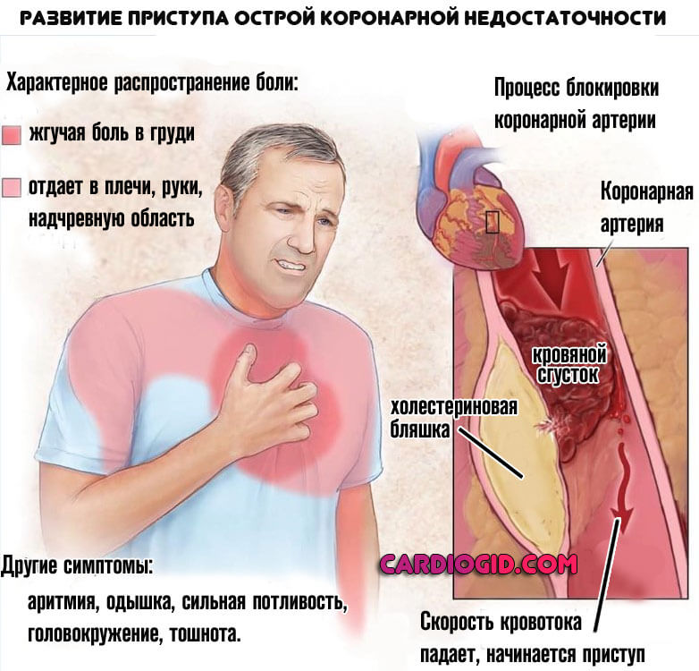 Симптомы атеросклеротической болезни сердца и ее лечение 