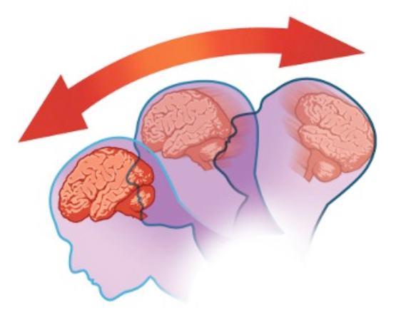 Сотрясение головного мозга – симптомы, признаки, первая помощь, степени повреждения 