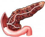 Фиброзные изменения поджелудочной железы 