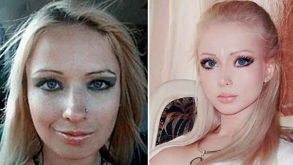  Фото валерии лукьяновой до и после операции
