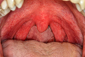 Красное горло, но не болит – возможные причины такого состояния и способы лечения 