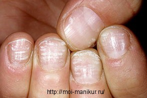 Белые пятна на ногтях – лейконихия 