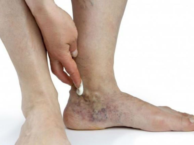 Лечение варикозной экземы на ногах — противовоспалительные, заживляющие мази 
