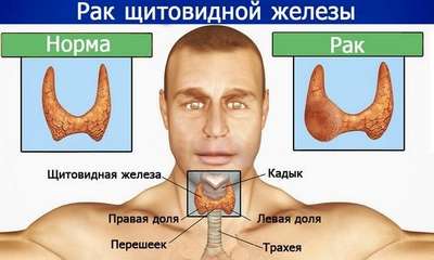 Рак щитовидной железы: причины, симптомы (фото), лечение, прогноз