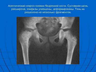 Асептический некроз головки бедренной кости