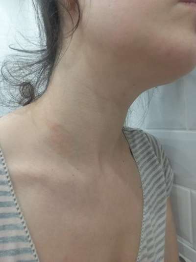 Что делать, если на шее появилось красное пятно и чешется? Дряблая кожа на шее