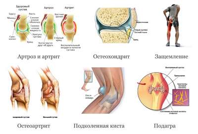 Болезни суставов