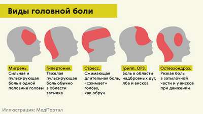 Мигрень и другие виды головной боли. Как отличить?