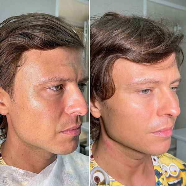 Прохор Шаляпин – пластика лица: фото до и после