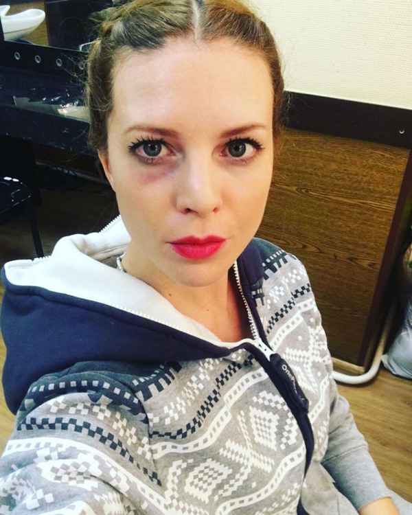 После слухов о второй беременности фото Натальи Подольской с синяком под глазом взволновало поклонников