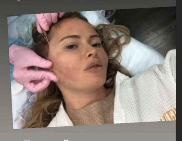 С новым лицом: Дана Борисова сделала пластическую операцию и показала видео процесса стоимостью в 17 000 рублей