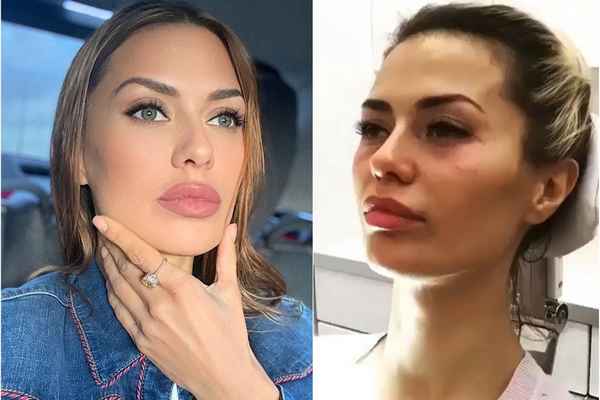 Из-за филлеров перекосило лицо: Виктория Боня пожаловалась на неудачную косметическую процедуру