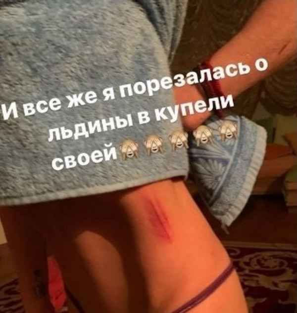 Анастасия Волочкова получила травму, но фанаты не пожалели известную балерину, а грубо раскритиковали