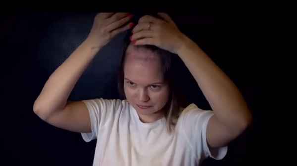 У дочери Владимира Левкина диагностировали paк мозга: 26-летняя дeвyшка потеряла волосы после лучевой терапии